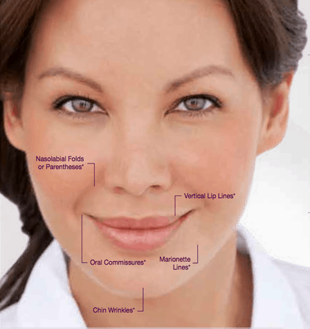 juvederm_a Juvederm XC in High Point & Greensboro NC