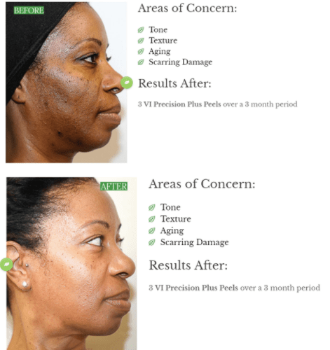 VI Peel in High Point & Greensboro NC