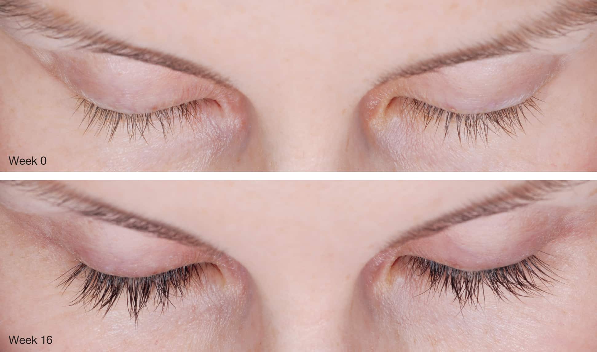 Latisse Before & After