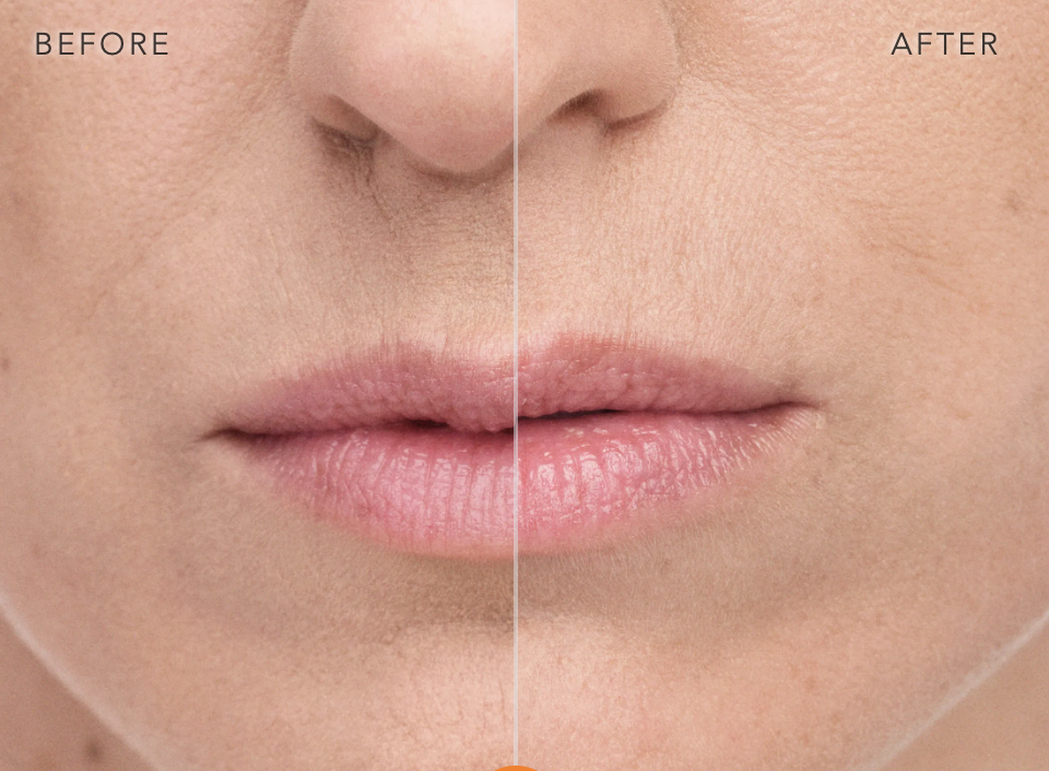 Belotero Balance + in High Point & Greensboro