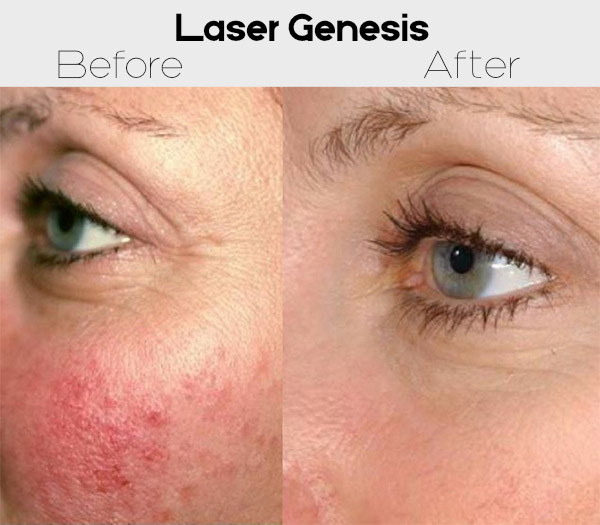 Laser Genesis - Before & After in High Point & Greensboro