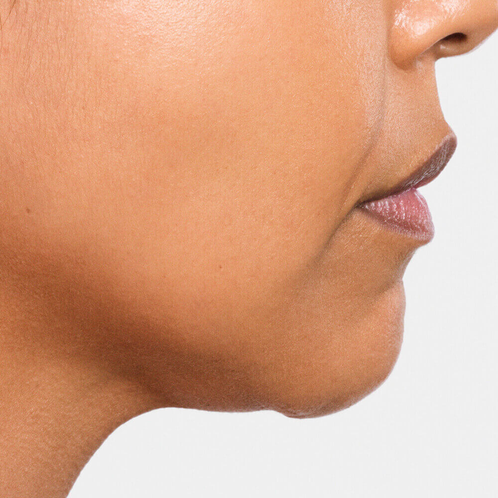 Radiesse Injectables in High Point & Greensboro