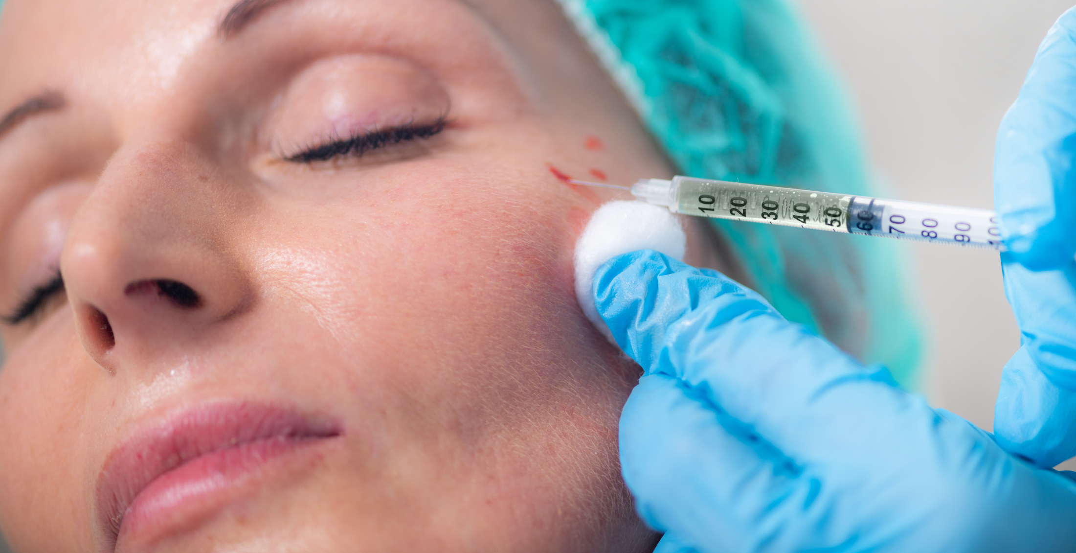 PRP Vampire Facials & Vampire Facelifts in High Point & Greensboro